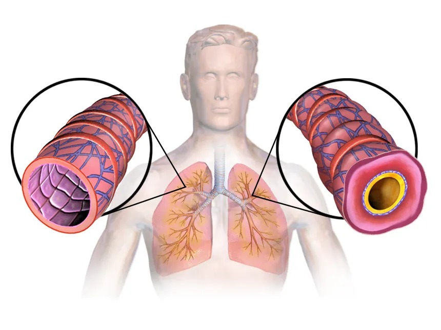 Allergic Bronchial Asthma